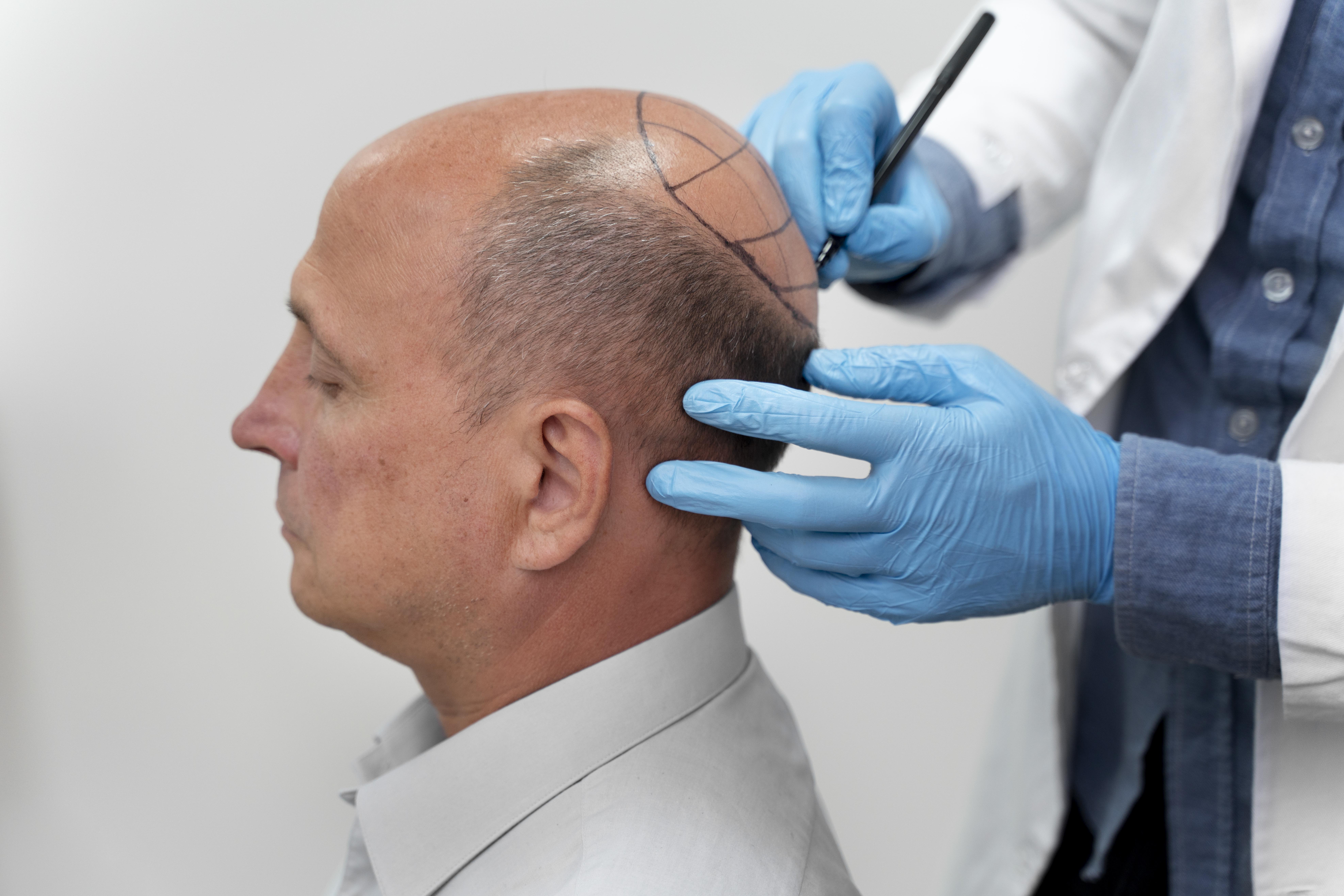 Hair Transplant in India for NRIs and Foreigners What to Know Before You Fly In