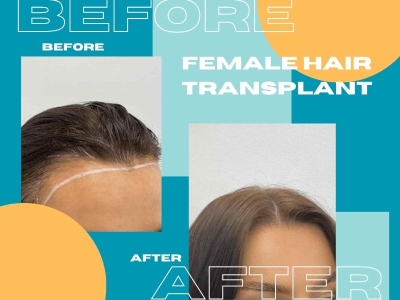 Selecting a Hair Transplant Surgeon in Mumbai: Marketing vs. Reality