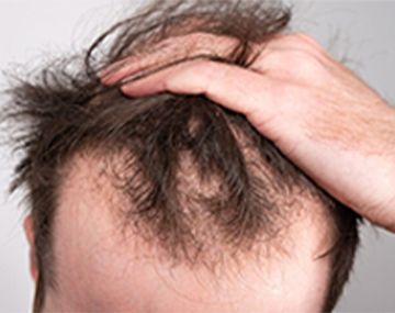 Best Hair Transplant Solutions for Male Pattern Baldness
